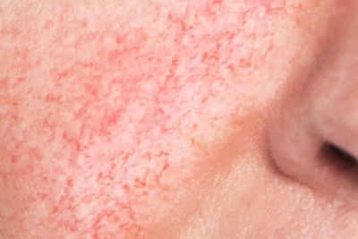 Couperose Control Serum